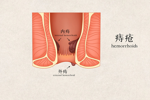 痔疮吃水果6001.jpg