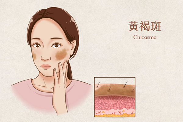 600黄褐斑医疗插画（企业商用）.jpg