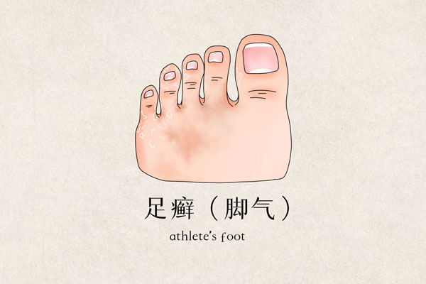 摄图网_401789776_banner_足癣医疗插画（企业商用）.jpg
