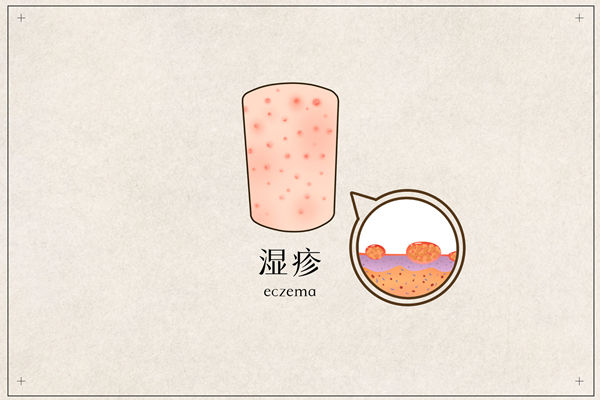 水痘.jpg