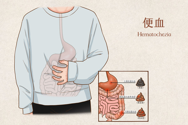 便血6001.jpg