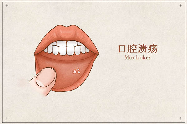 口腔溃疡.jpg
