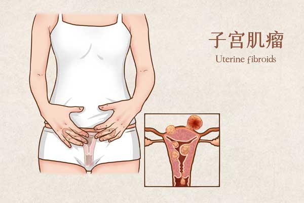 子宫肌瘤医疗.jpg