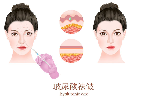 600_玻尿酸祛皱纹医美插画（企业商用）.jpg