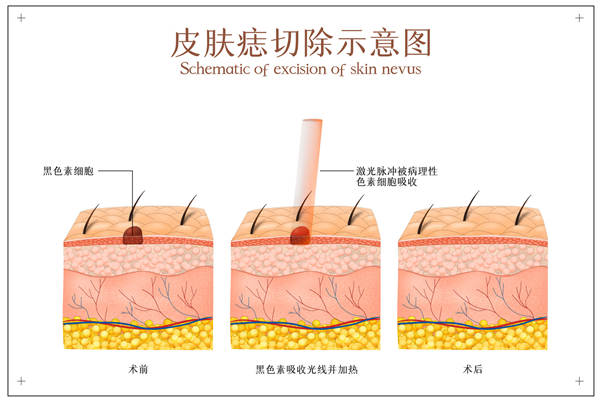 点痣(1).jpg