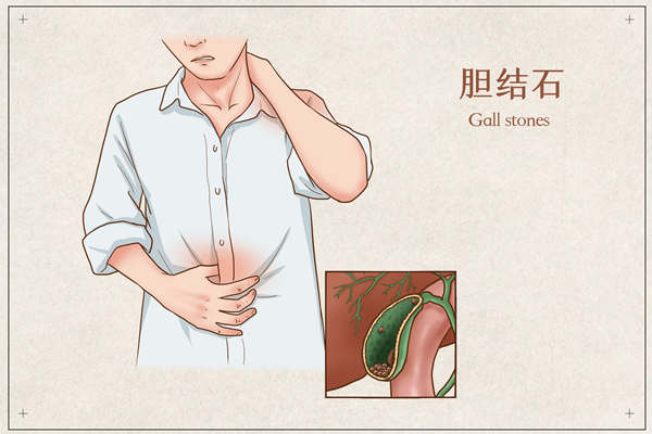 胆结石_副本.jpg