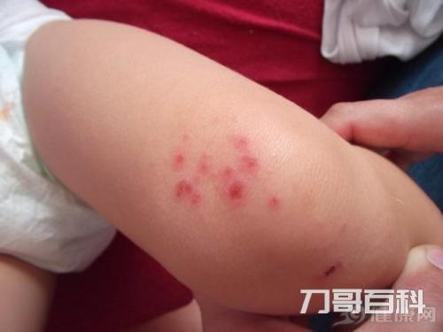 红痦子是怎么回事(红痦子怎么去除小妙招) 红痦子是怎么回事(红痦子怎么去除小妙招)