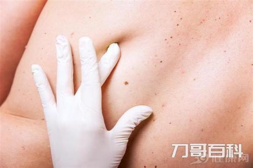 红痦子是怎么回事(红痦子怎么去除小妙招) 红痦子是怎么回事(红痦子怎么去除小妙招)